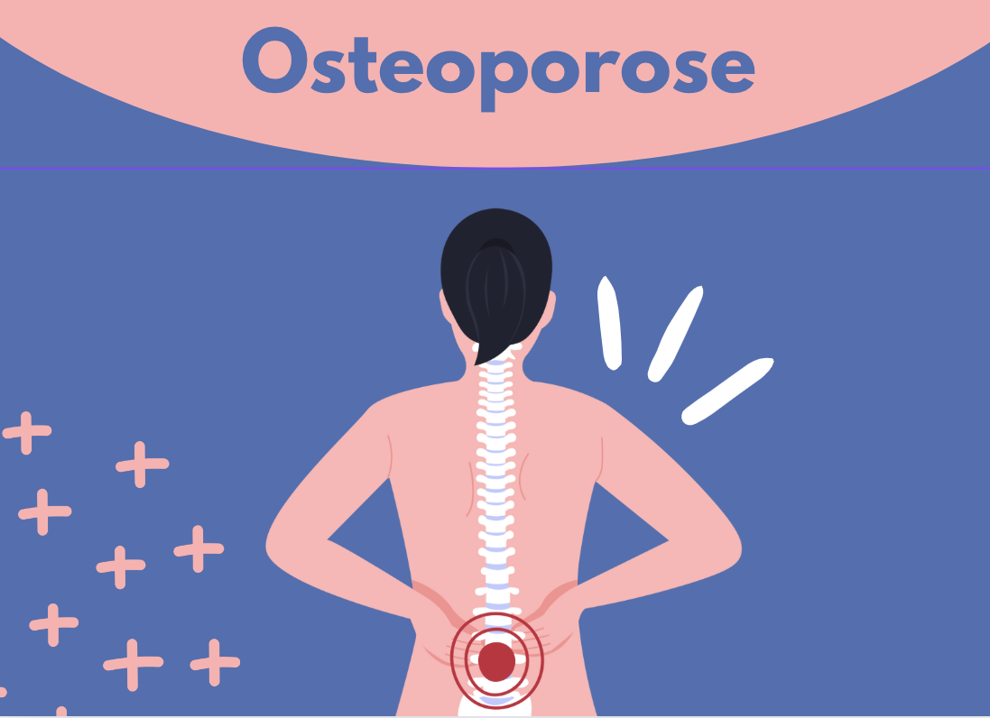 Illustration einer Frau mit markierter Wirbelsäule bei Osteoporose